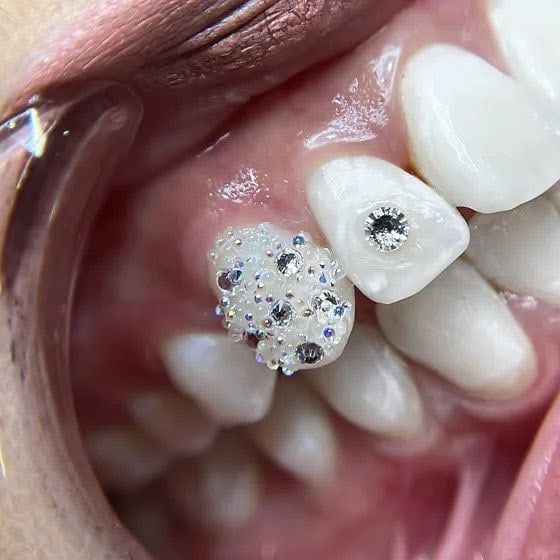 Iced-Out Tooth: Zahn dicht besetzt mit kleinen Kristallen