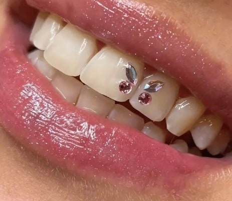 Lächeln mit Zahnschmuck aus rosafarbenen und klaren Kristallen